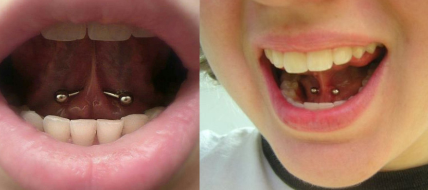 frenulum